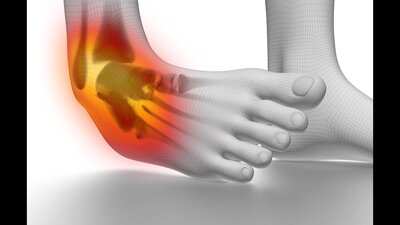 Sprains and Possible Fractures