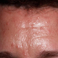 Talgklierhyperplasie ultra skin clinic huidtherapie