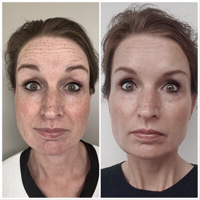 Botox before after door Lizenka Adriaanse cosmetisch arts Rotterdam