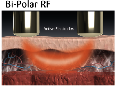 Bi-polar RF from Sinclair helps make the vaginal procedure comfortable and painless.