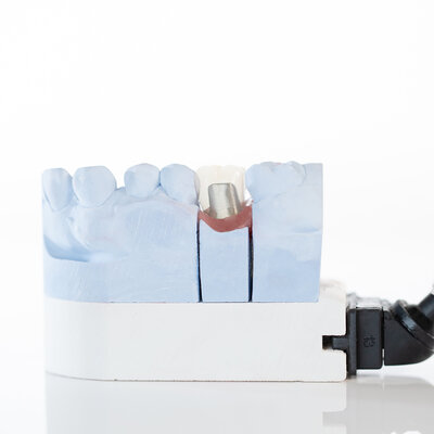 Olympus-Dental-Ceramics-Implant