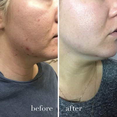 Bombshell-Acne-Facial-Before-After