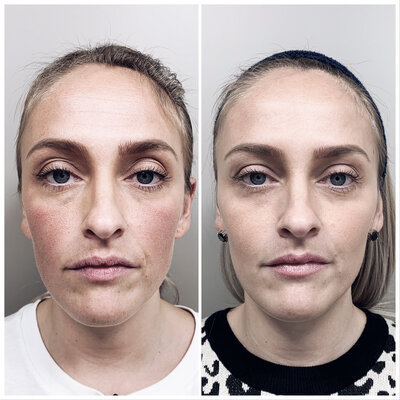 Botox before after door Lizenka Adriaanse cosmetisch arts Rotterdam