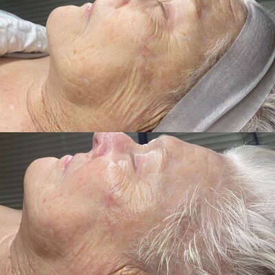Before and after a Hydrafacial