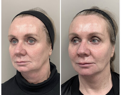 Liquid facelift door cosmetisch arts Lizenka Adriaanse in Rotterdam