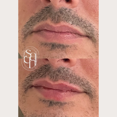 lip filler before and after indian woman indian woman lip filler asian woman lip filler skin of color juvederm restylane