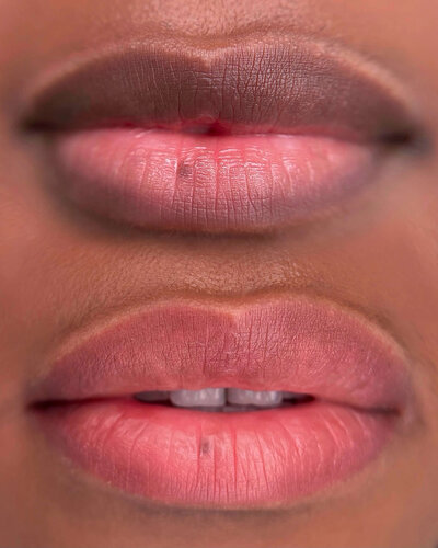 Healed Lip Neutralization new york