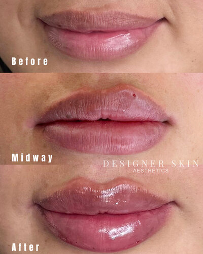 Before and after lip filler treatment in Huntington Beach