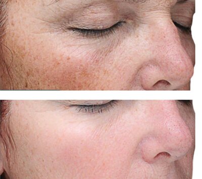 Before and after image showcasing the results of the VI Peel: Precision Plus at Refined Medical NY. This treatment helps improve skin tone, texture, and pigmentation, revealing brighter, smoother skin.