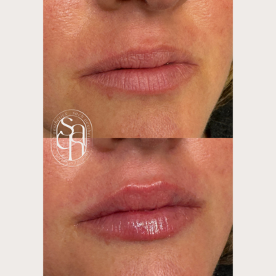 lip filler before and after on smaller, thin lips
