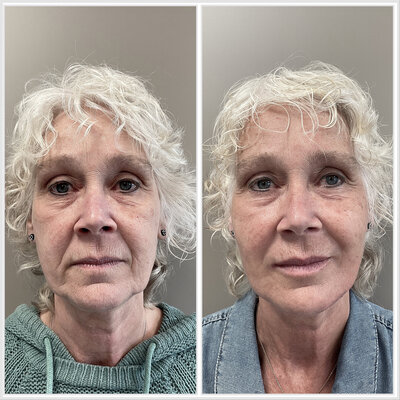 Before after liquid facelift Lizenka Adriaanse cosmetisch arts Rotterdam
