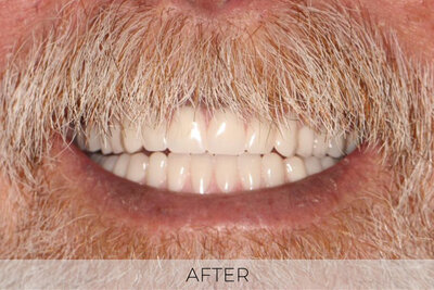 implant denture after