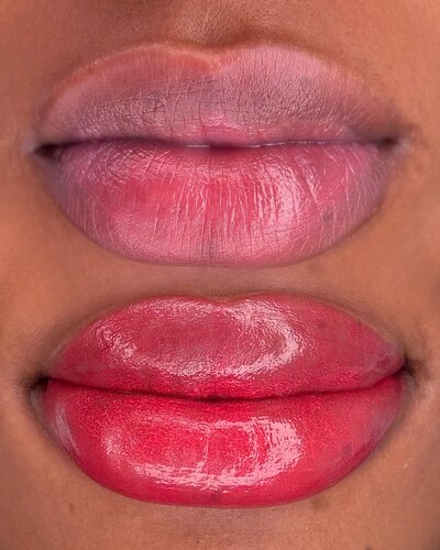 lips neutralization in New York