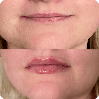 Lip filler procedure from Refresh Aesthetics