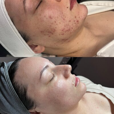 Advanced Skin Care in Santa Clara, CA