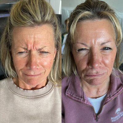 Before and after of womans face before and after Botox