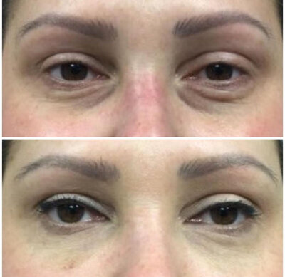 Before and after images of under eye brightening using dermal filler at Refined Medical NY. This treatment targets dark circles and hollows, restoring a refreshed, youthful appearance in East Setauket, Long Island.