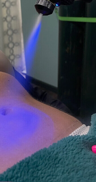 A close-up of a cryotherapy treatment being applied to a client's stomach, with a therapist's hand resting on a towel, showcasing the advanced cryotherapy services at 212 Salon, Spa, & Barbershop.