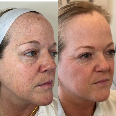 BBL laser session targeting sun damage and pigmentation at a Burlington med spa.