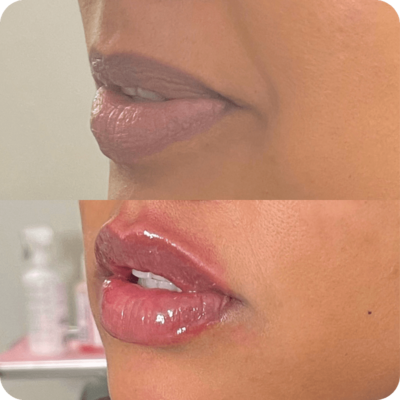 Results from before and after a Juvederm lip filler at Refresh Aesthetics