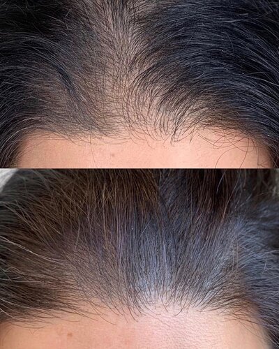 Before and after hair restoration treatment showing improved hair density at NAHT Medspa London