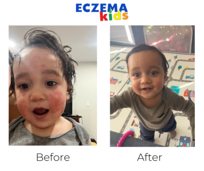 eczema elimination method