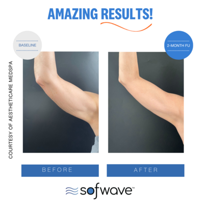 Set-45-Upper-Arm