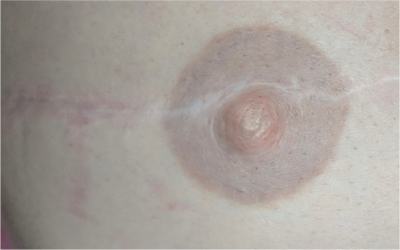 areola_before