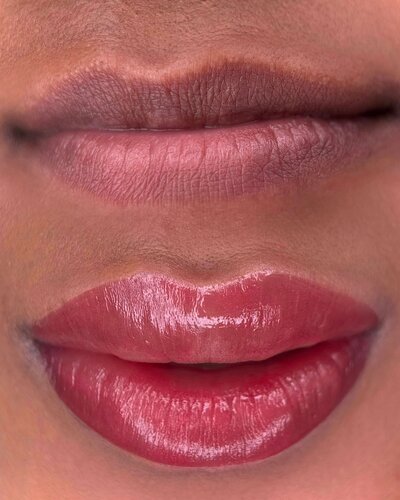 Lip Neutralization New York