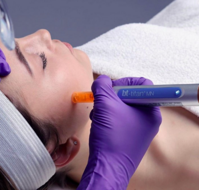 nano needling |microneedling | skincare | facials | glowing skin | professional | dermalogica | clear skin | hydrafacial | hydrating |  beauty | leicester | oadby | exfoliation