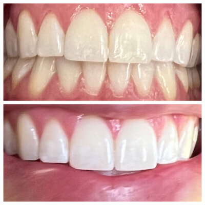 Before & After Teeth Whitening experience at WhitenUp Teeth Whitening Spa. Top photo shows teeth before, which are stained and yellow. Bottom photo shows teeth after, which are bright and white.