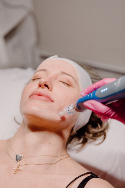 microneedling for acne scarring and fine lines in Barrington