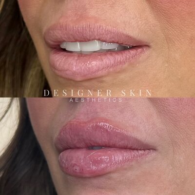 Before and after lip filler treatment in Huntington Beach