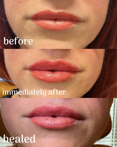 Lip filler before and after photo
