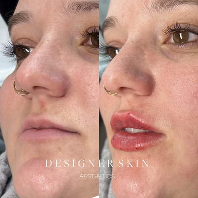 Before and after lip filler treatment in Huntington Beach