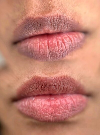 Lips Neutralization | Dark Lips Color Correction - New York