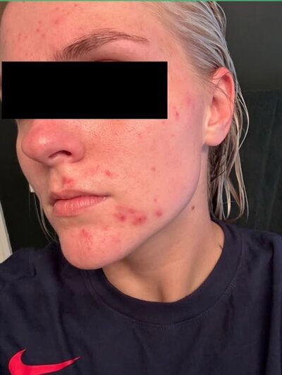 Chin pimples and hormones