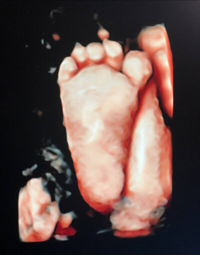 Baby Foot in 3D image ultrasound