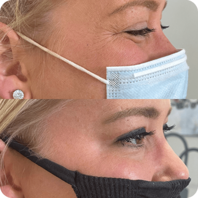 Crows feet filler service - before and after