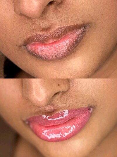 Lip Neutralization new york