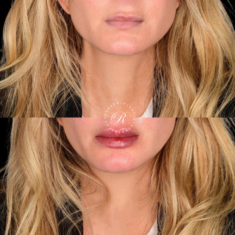 Non-surgical Lip Augmentation RPS Before & Afters.zip - 15