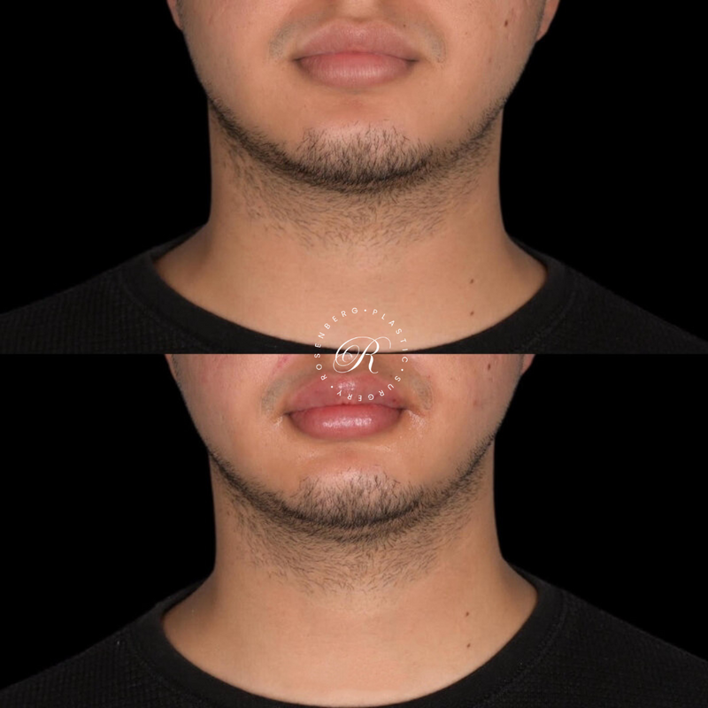 Non-surgical Lip Augmentation RPS Before & Afters.zip - 11
