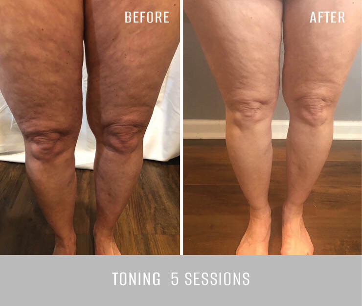 total.sculpting Check this CRYOSKIN TONING transformation and these  legs!🔥😮 This is Cryoskin's power: diminish cellulite, tighte