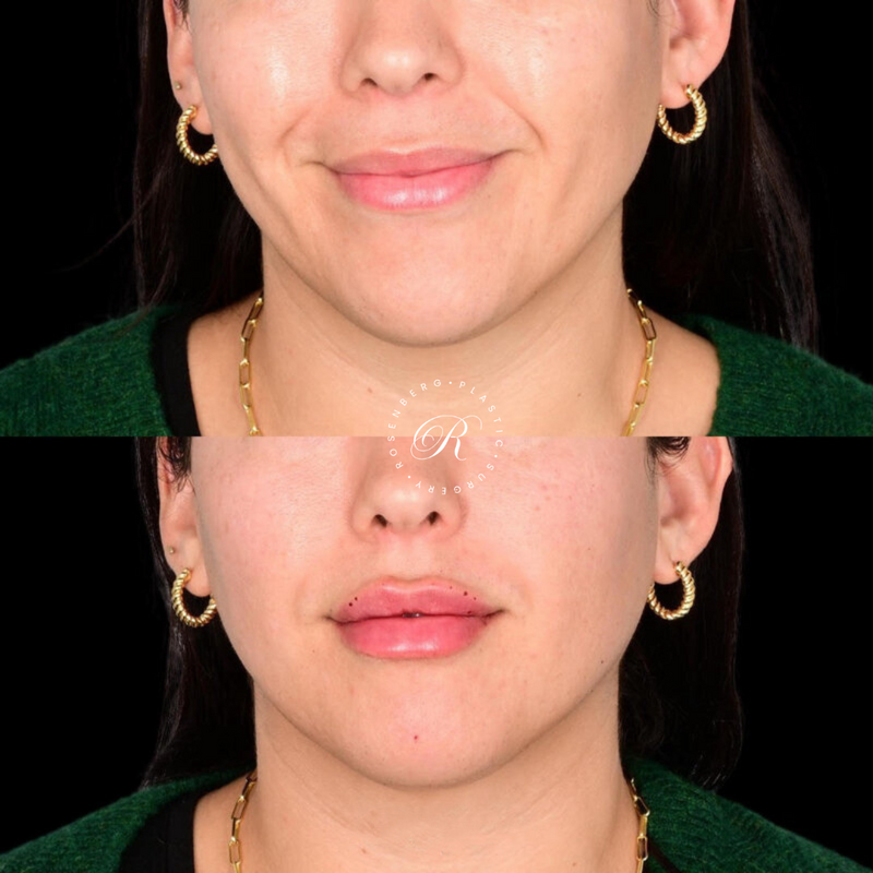 Non-surgical Lip Augmentation RPS Before & Afters.zip - 7