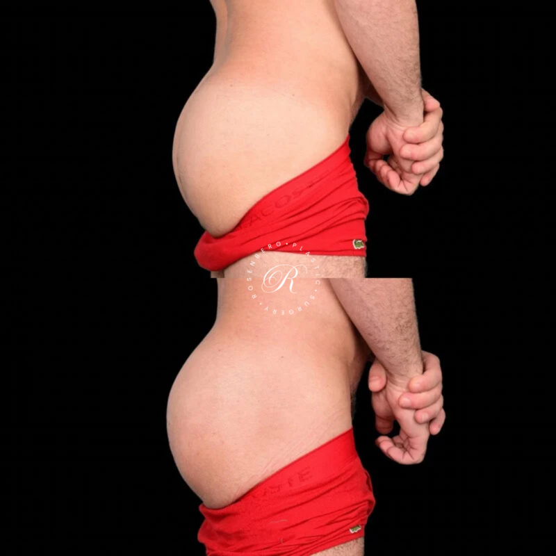 BeverlyBum RPS Before & Afters - 2