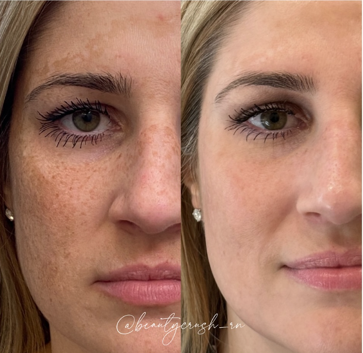 Hyperpigmentation Cream