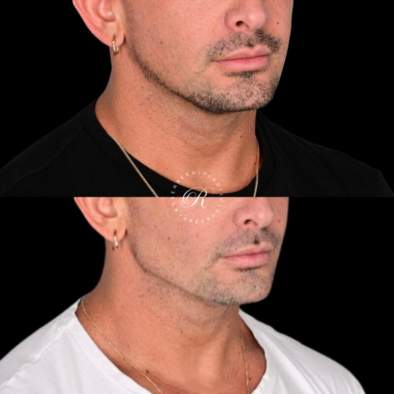 Non-surgical ChinJaw Augmentation RPS Before & After.zip - 49