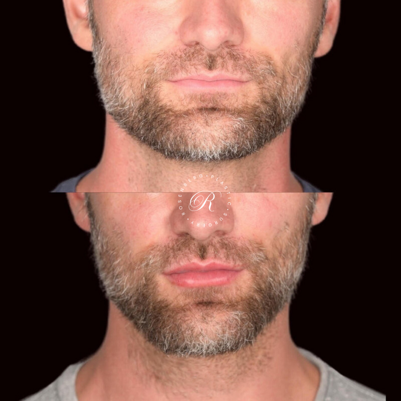 Non-surgical Lip Augmentation RPS Before & Afters.zip - 6