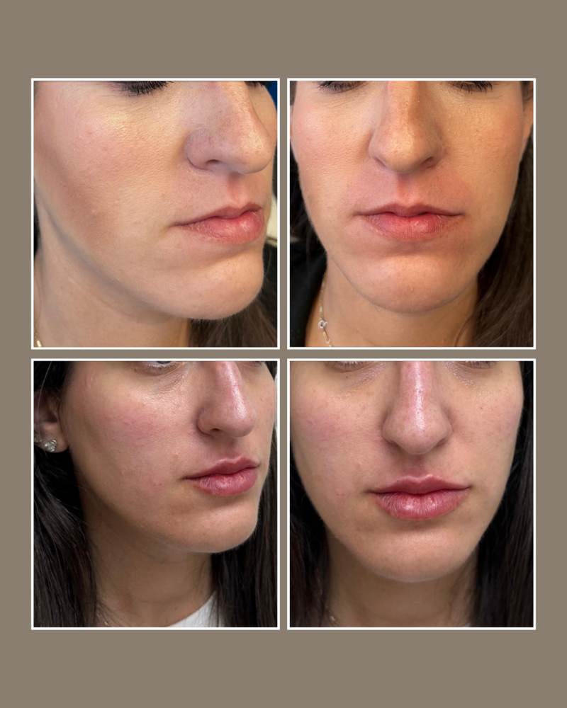 facial harmonization - Injectables - Glösense Dermatology and Aesthetics, Miami