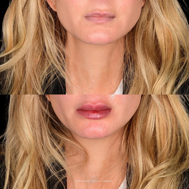 Lip Filler Results